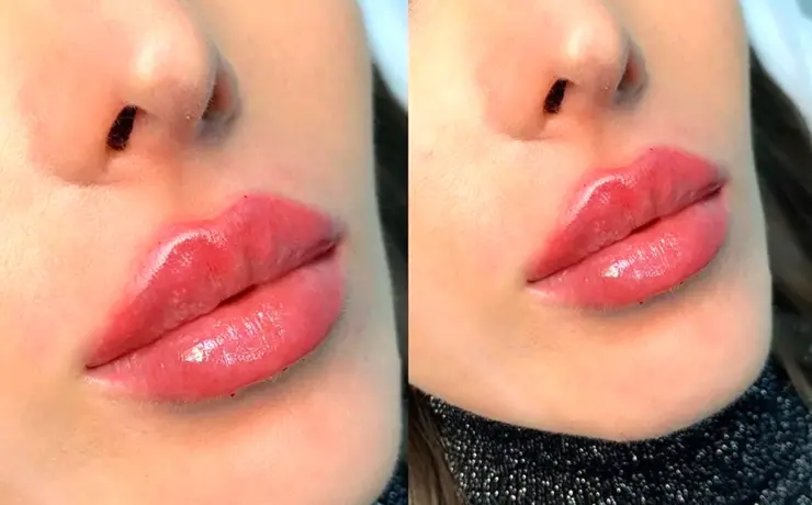 Увеличенные губы красивые